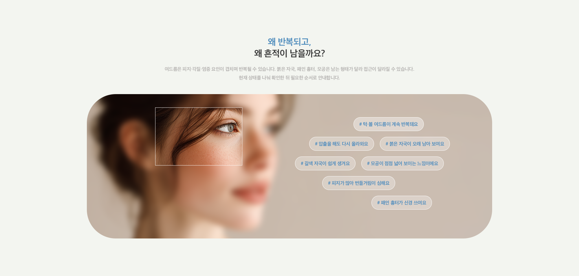 [왜 반복되고, 왜 흔적이 남을까요?] # 턱·볼 여드름이 계속 반복돼요 # 압출을 해도 다시 올라와요 # 붉은 자국이 오래 남아 보여요 # 갈색 자국이 쉽게 생겨요 # 모공이 점점 넓어 보이는 느낌이에요 # 피지가 많아 번들거림이 심해요 # 패인 흉터가 신경 쓰여요